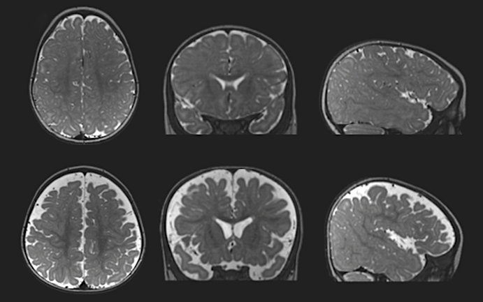 Brain swell: A 6-month-old infant who was later diagnosed with autism (bottom row) had excess cerebrospinal fluid surrounding the brain (depicted in white) compared with a typically developing infant (top row).